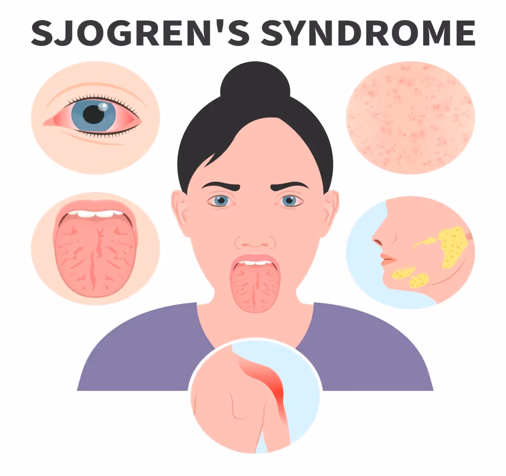 Sjögren’s Syndrome: Symptoms & Treatment