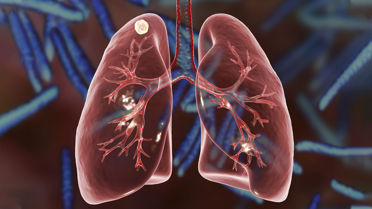 Pulmonary (Lung) Nodules: Causes, Symptoms & Treatment