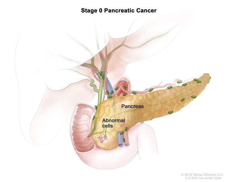 Pancreatic Cancer: Symptoms, Diagnosis & Treatment