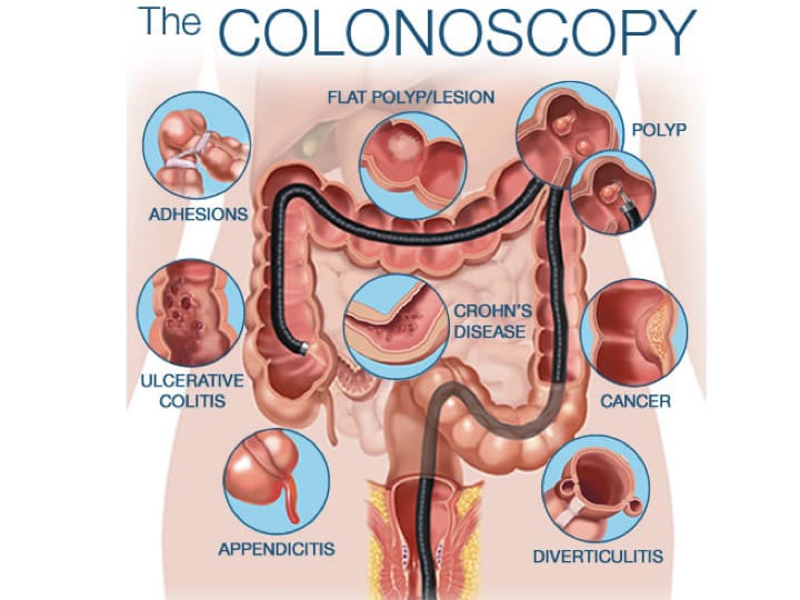 Colonoscopy: Preparation and Procedure Details