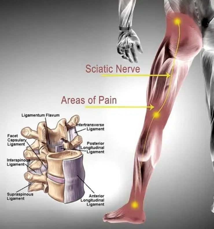 A diagram showing the location of nerves related to sciatica