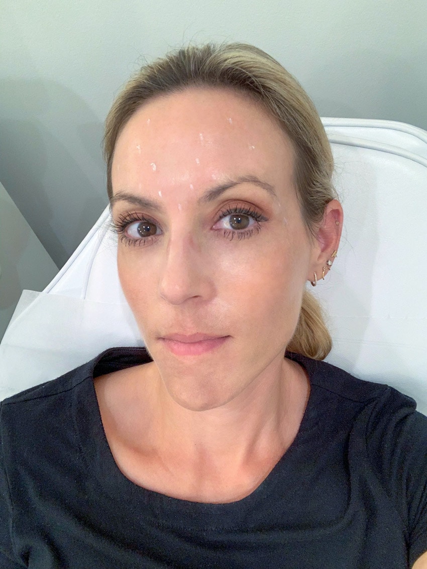 Before and After Botox: This is Why I Love The Results