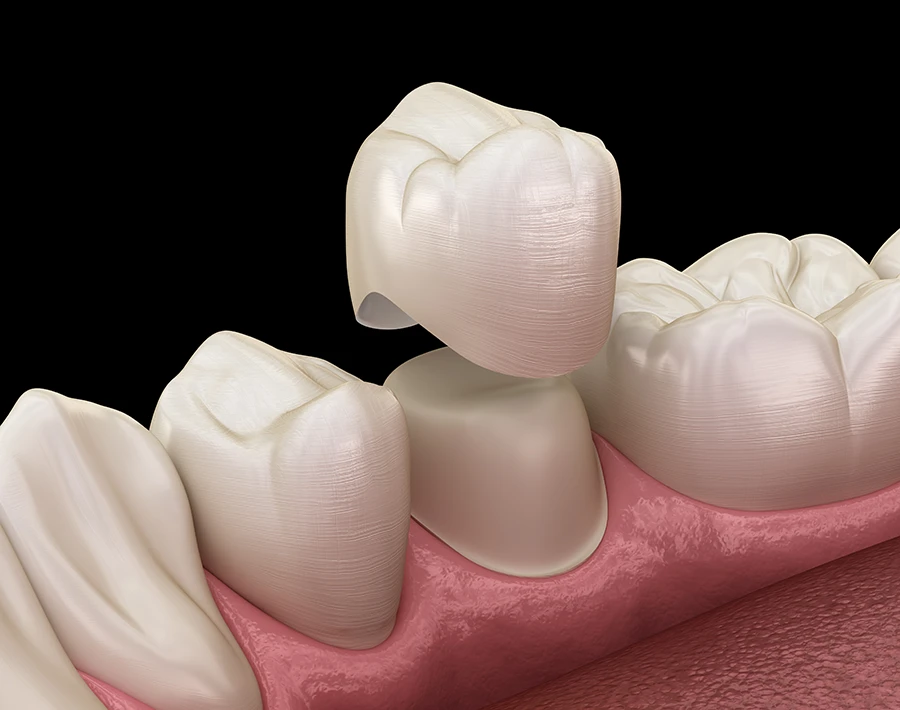 3D illustration of a dental crown being placed on a prepared tooth in the lower jaw.
