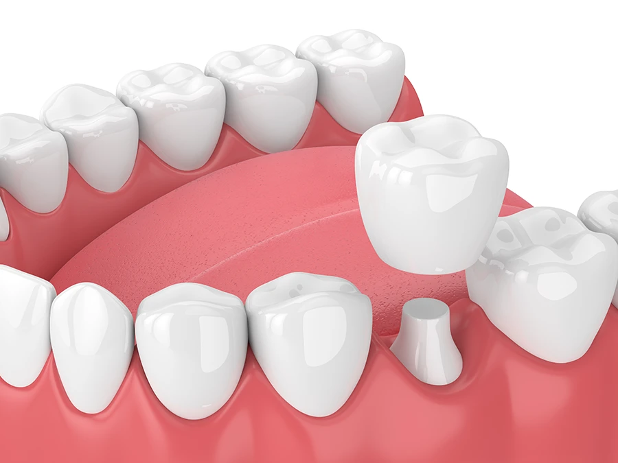 3D illustration of a dental crown being placed on a prepared tooth in a lower jaw with surrounding teeth and gums.