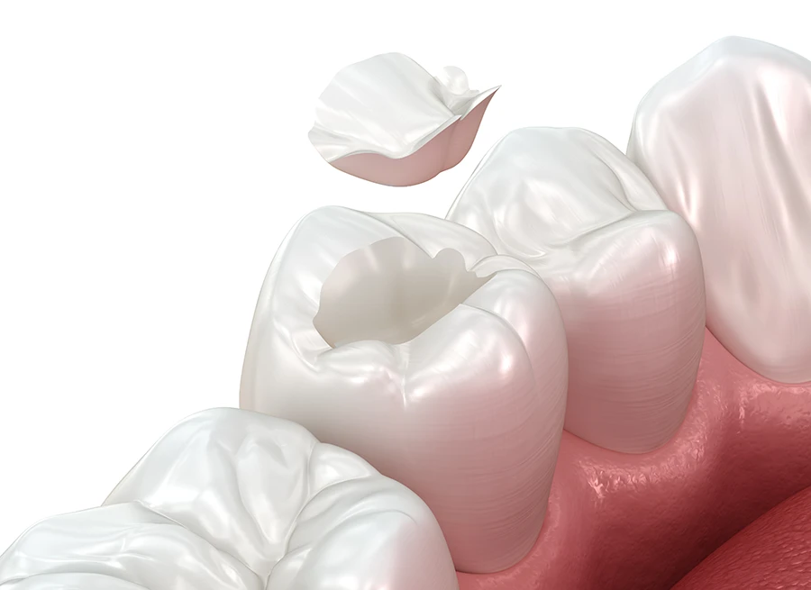 3D illustration of a dental inlay being placed into a cavity on a molar tooth, showing surrounding teeth and gums.