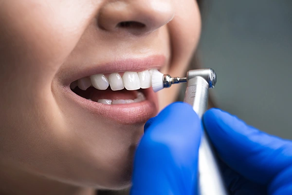 Close-up of dental cleaning with a rotating brush on a patient's front teeth.