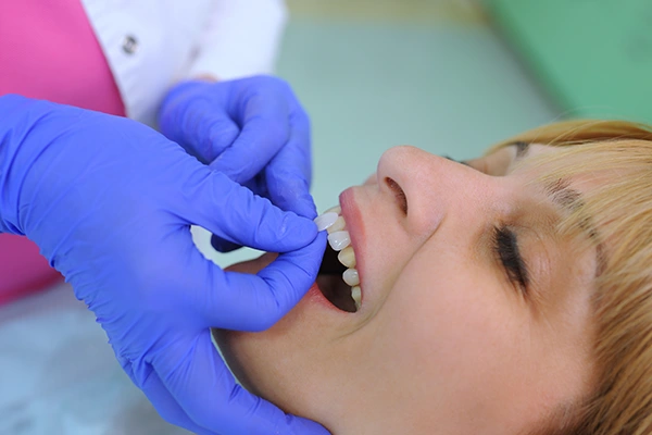 Dentist wearing blue gloves fitting a dental veneer on a patient's upper front teeth.