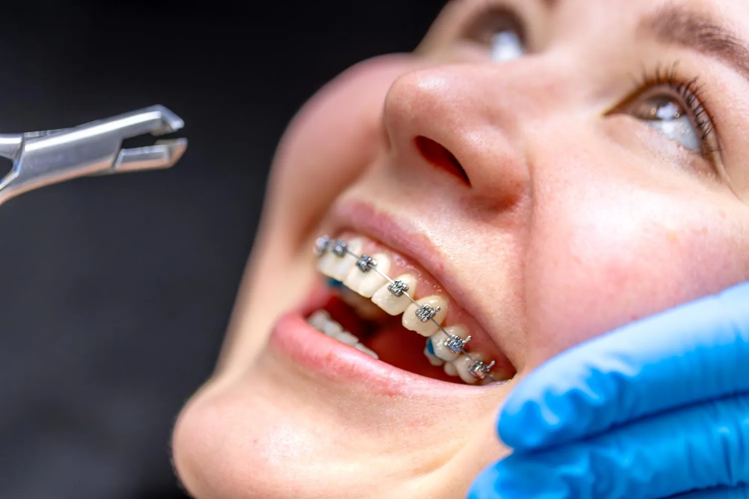 Close-up of a smiling person with braces during a dental checkup, with a gloved hand and dental tool nearby.
