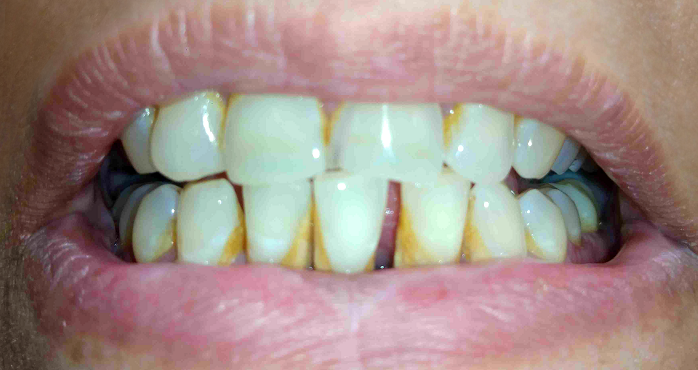Teeth-stains-dentaldost
