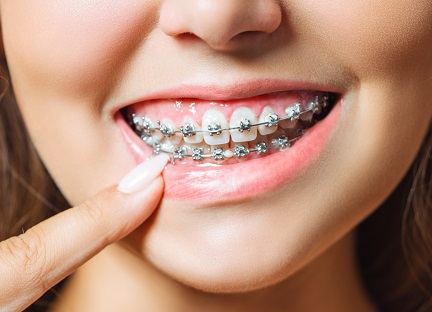 metal-braces-dental-blog