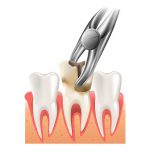 Tooth extraction of dead tooth