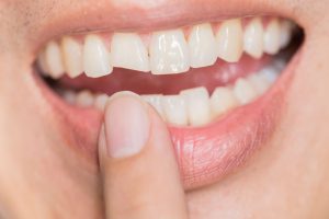 fractured tooth