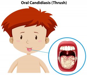 Oral Candidiasis