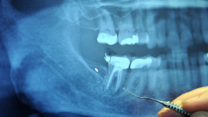 Gum Mishap of thai women