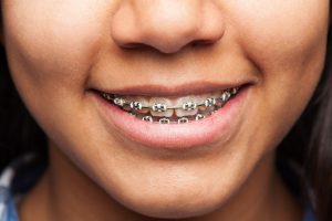 Orthodontics treatment