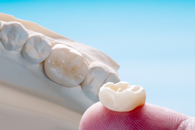 single-teeth-crown-bridge-equipment-model-express-fix-restoration-dental-blog