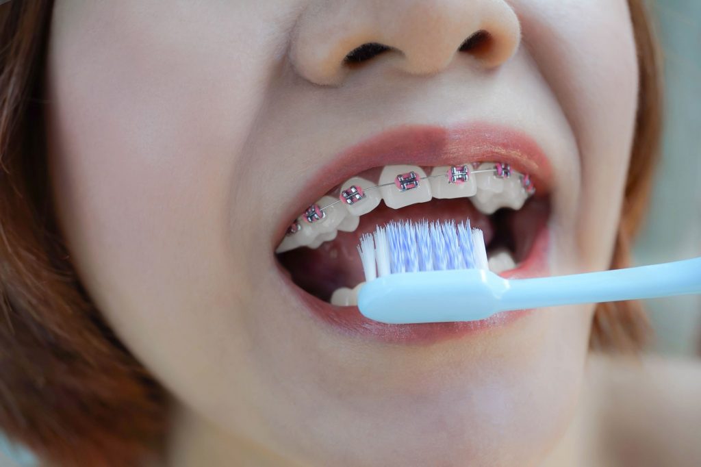 woman with braces brushing teeth