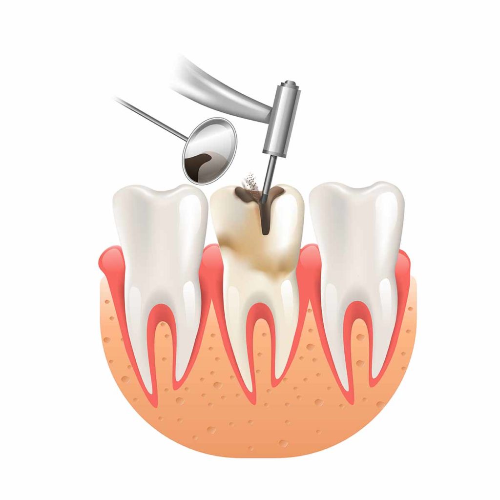 teeth-filling-dental-dost-dental-blog