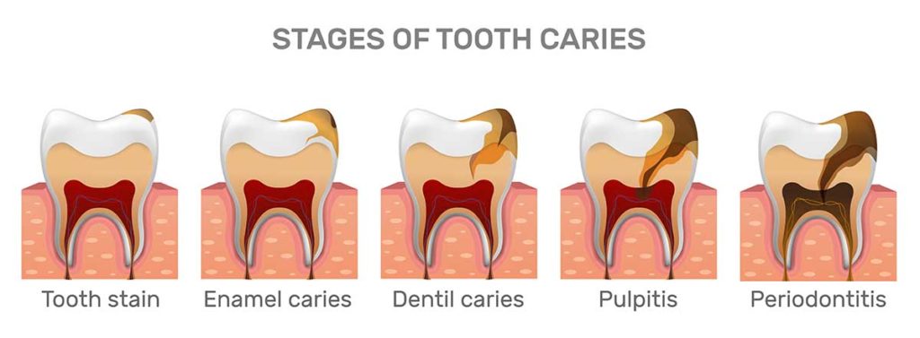 stages-of-tooth-caries-dental-dost-dental-blog