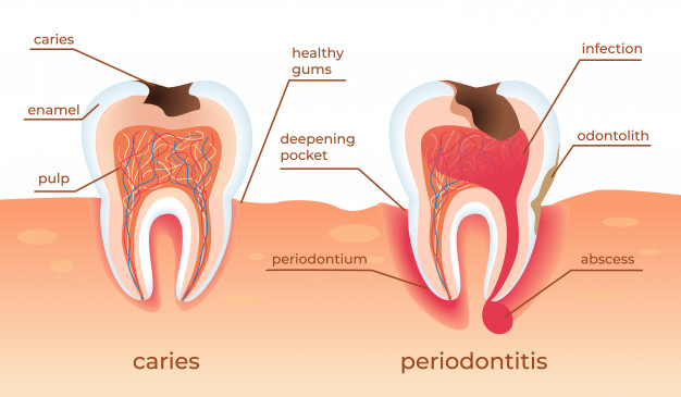 unhealthy-teeth-stand-raw-gums-tooth-decay-dental-blog