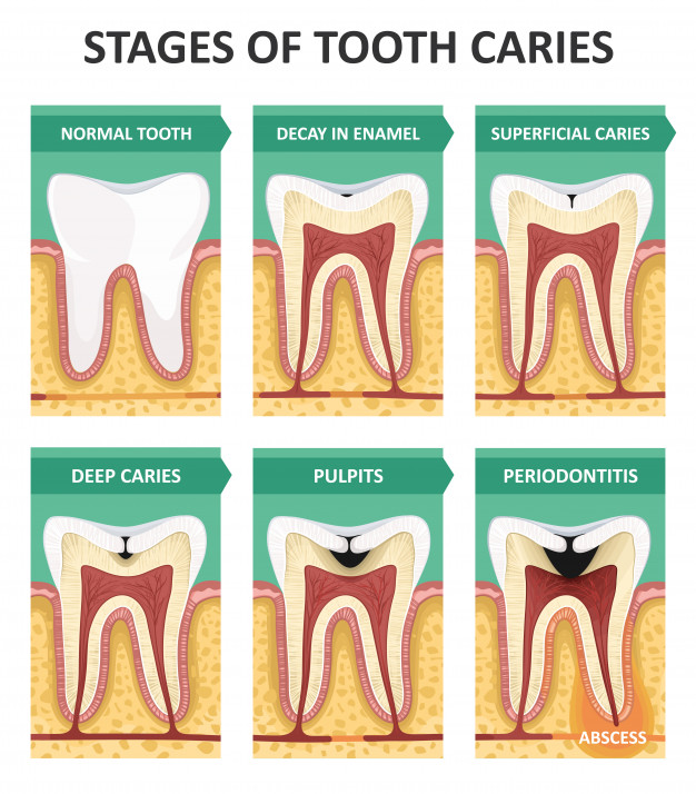 stages-tooth-caries-dental-blog