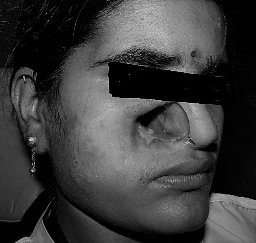 Mucormycosis  patient image