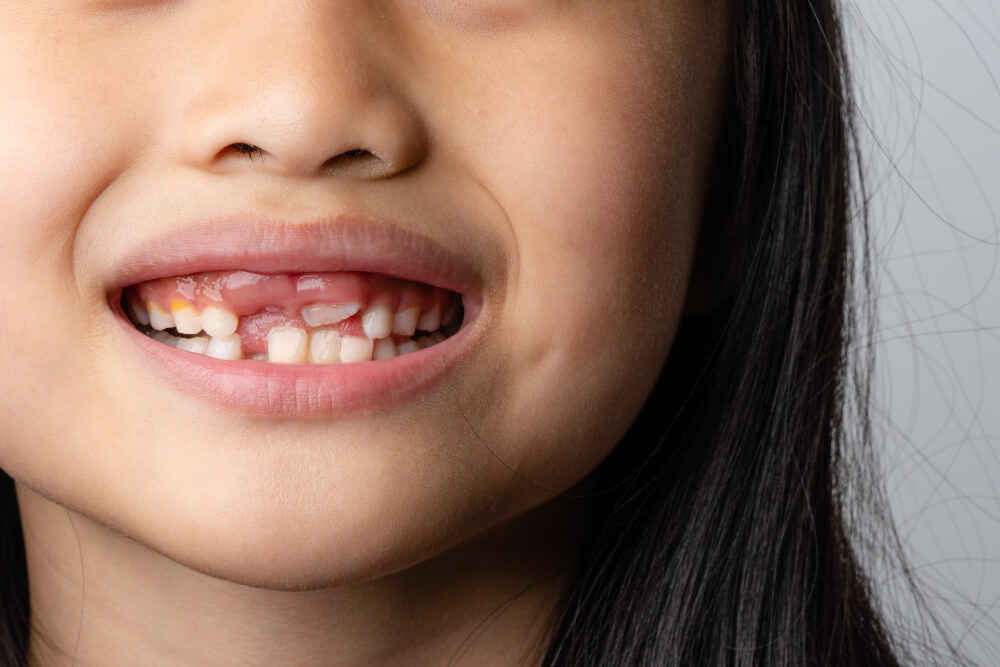 childs-teeth-8-year-old-little-girl-lost-baby-incisor