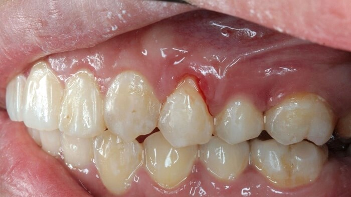 Bleeding gums