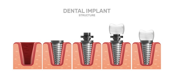teeth-implant-structure