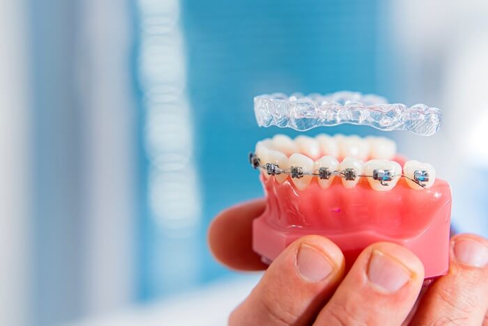 smile-shows-transparent-aligners