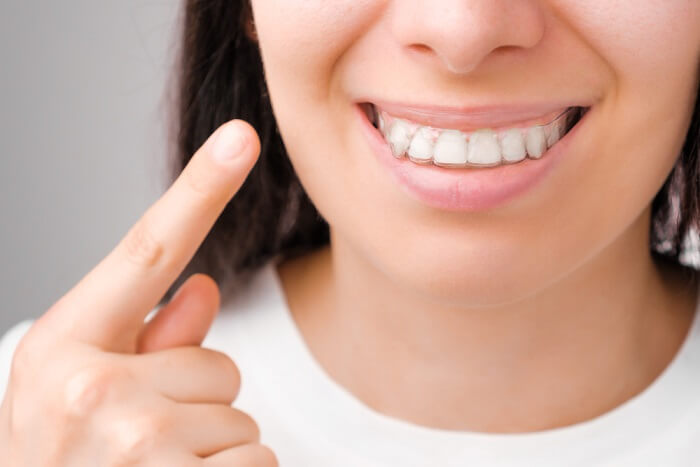 woman-with-perfect-smile-shows-with-finger-transparent-aligners-her-teeth