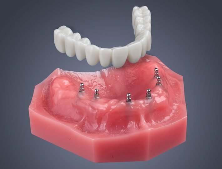 dental mini implants image
