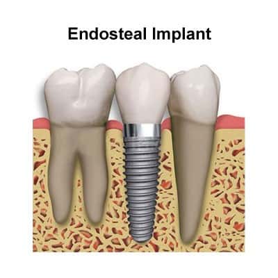 Endosteal implants