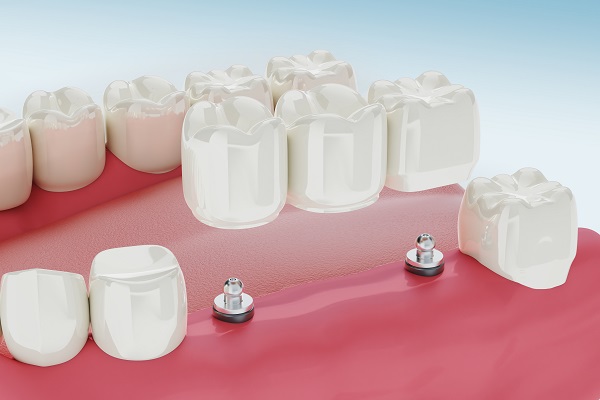 Dental Implants Treatment Procedure. Medically accurate 3D illus