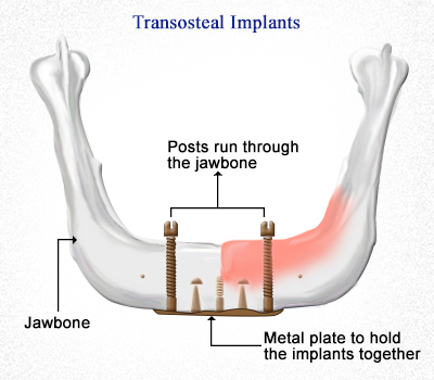 types of dental implants ? transosteal-implants