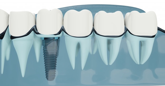 dental-implants-treatment-procedure-image