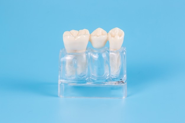 plastic-dental-crowns-imitation-dental-prosthesis-dental-bridgeDental implants vs dental bridges and dentures