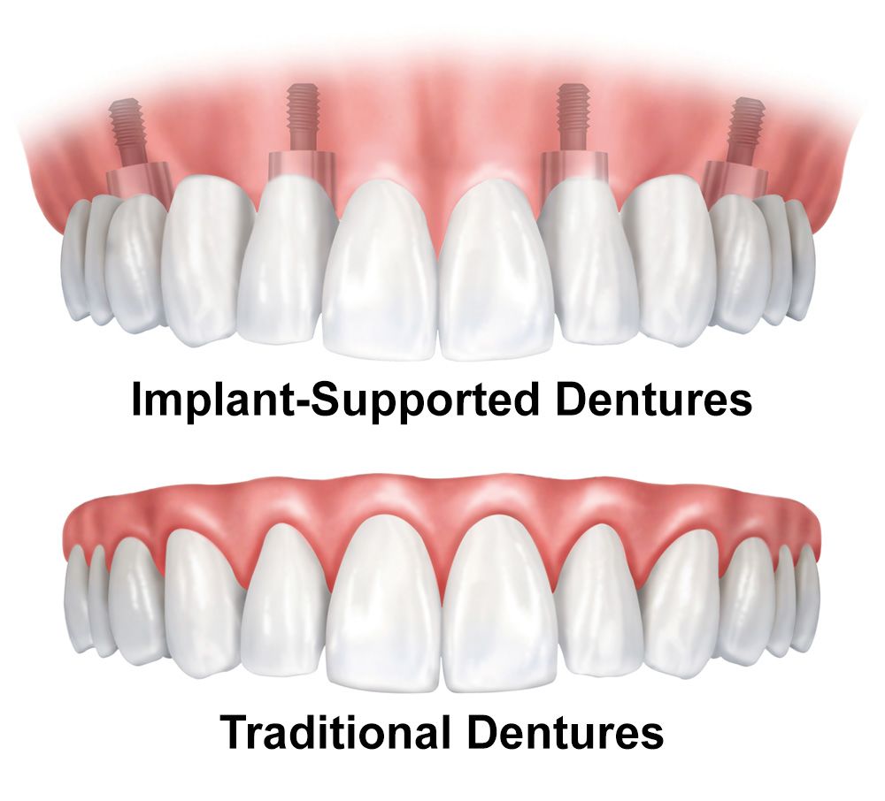 Dentures and Implant