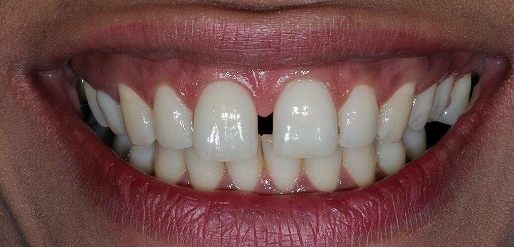 What Does Midline Diastema Mean
