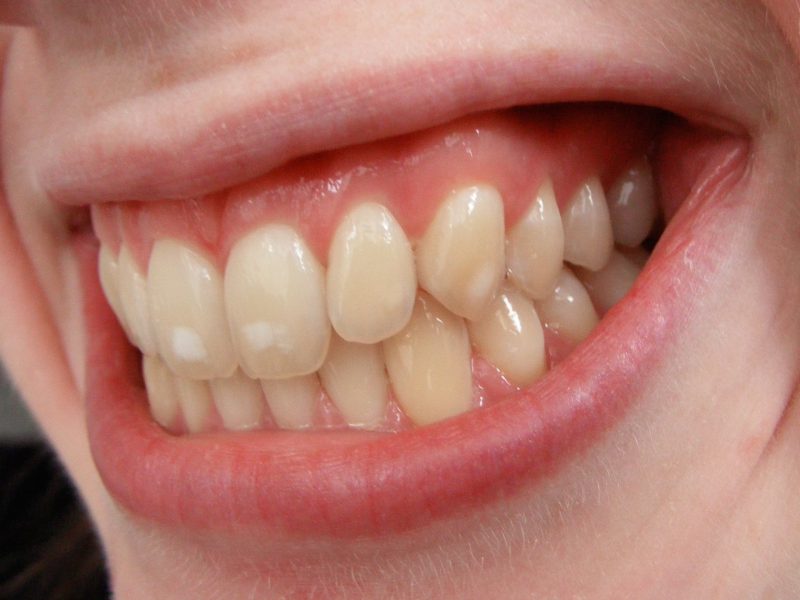 stains on teeth