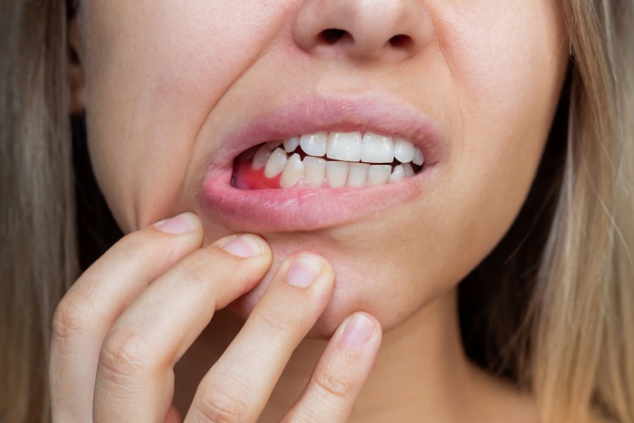gum-inflammation-closeup-young-woman-showing-swollen-and-pluffy-bleeding-gums