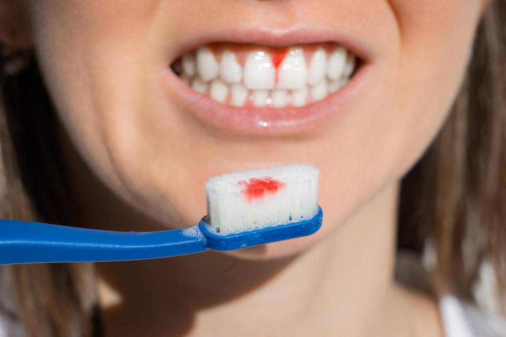 woman-mouth-with-bleeding-gums-during-teeth-brushing