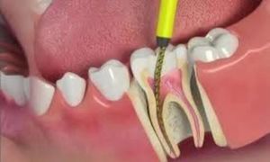 License needed Root canal Treatment