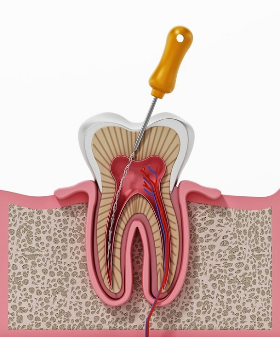 root-canal-treatment-process
