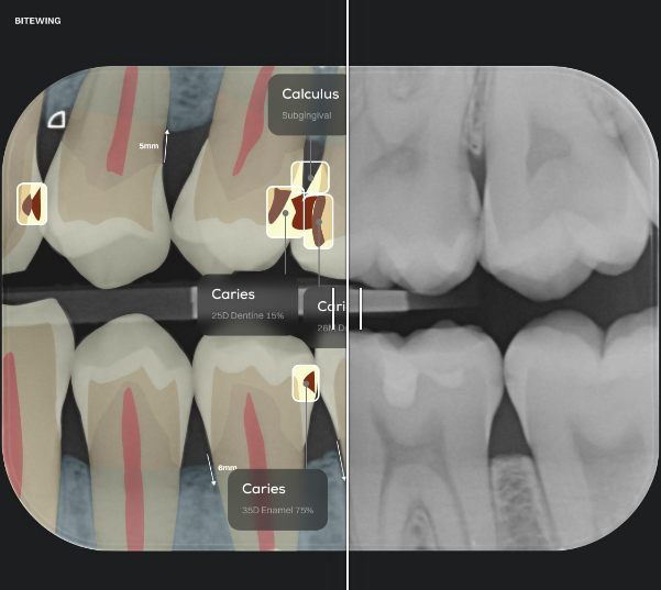 Dental Diagnosis of caries using AI