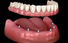 Implant-supported overdentures