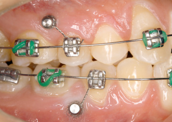 Orthodontic mini-implants used for anchorage