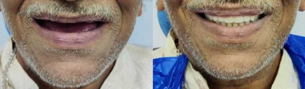 dentures before and after