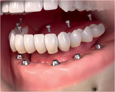 Implant-retained fixed bridge