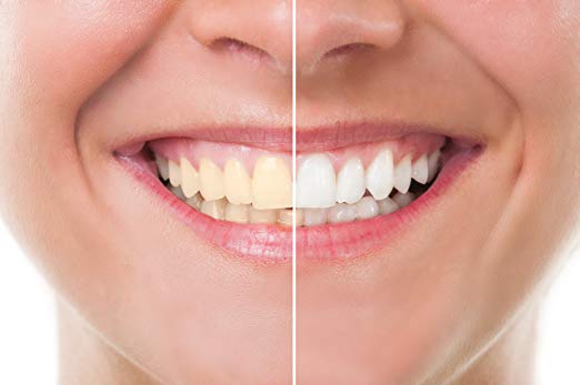 Image of a smile makeover showcasing transformed teeth